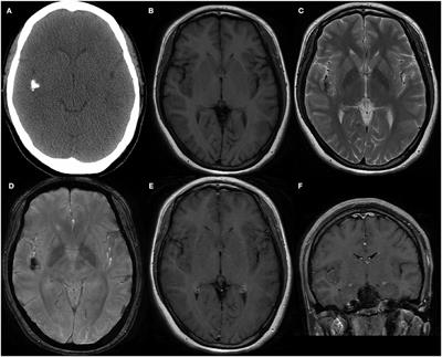 Sylvian Fissure Meningiomas: Case Report and Literature Review